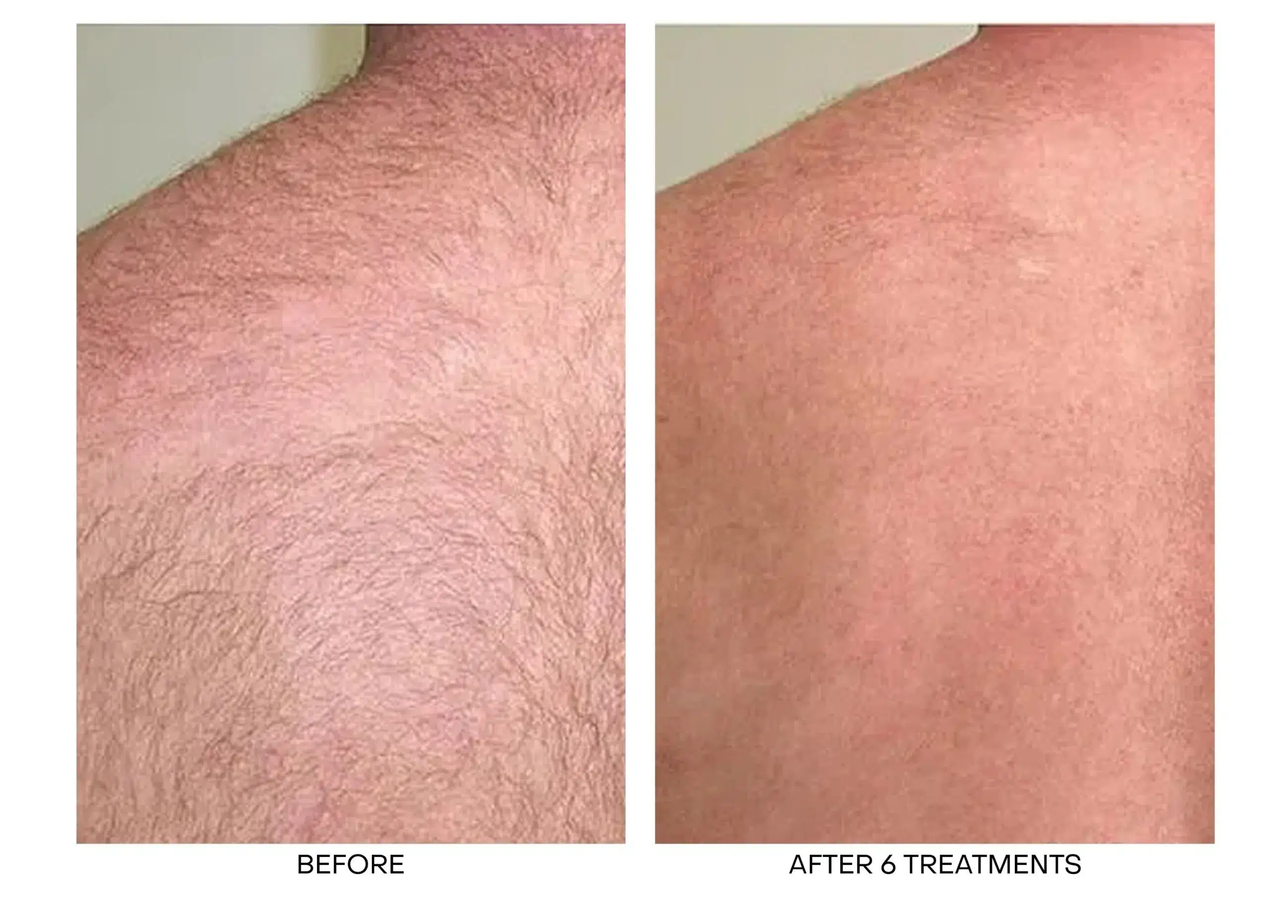 Laser Hair Removal Winnipeg
